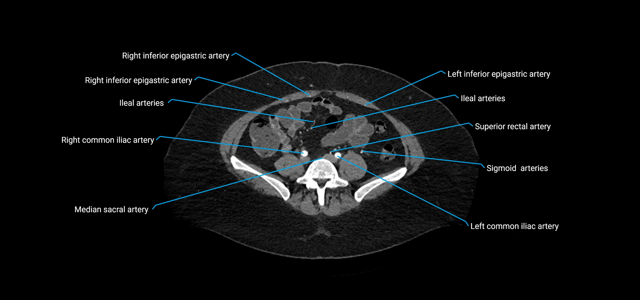 CTA abdomen axial cross sectional anatomy labelled image_162 (2).webp